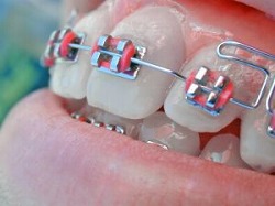aparelho-dental-501564-m